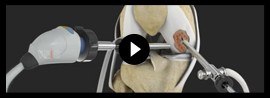Patient Education Video